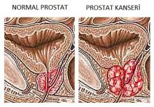 prostat kanseri şematik görünüm